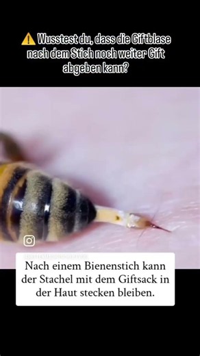 Ein Insektenstich ist meist harmlos – aber richtig handeln ist wichtig! Stachel entfernen