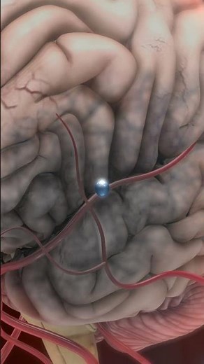 How Paralysis Happens in 60 Seconds (Animated Explanation)#shorts