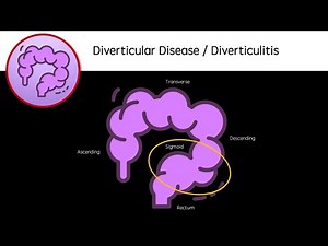 Diverticular Disease and Diverticulitis