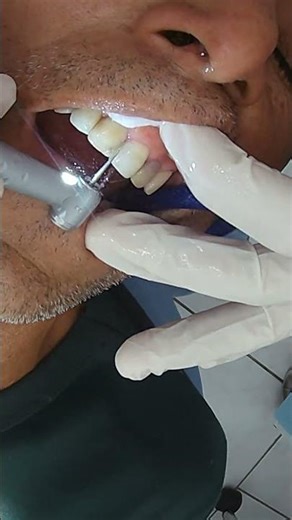 Dentist Fixes Tooth in Minutes!