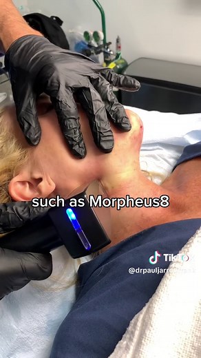 𝐄𝐱𝐩𝐞𝐫𝐢𝐞𝐧𝐜𝐞 𝐭𝐡𝐞 𝐌𝐚𝐠𝐢𝐜 𝐨𝐟 𝐅𝐚𝐜𝐞𝐓𝐢𝐭𝐞 𝐟𝐨𝐫 𝐚𝐧 𝐄𝐟𝐟𝐨𝐫𝐭𝐥𝐞𝐬𝐬 𝐓𝐫𝐚𝐧𝐬𝐟𝐨𝐫𝐦𝐚𝐭𝐢𝐨𝐧 FaceTite is a minimally invasive procedure that delivers radiofrequency energy under the skin’s surface to melt fat, stimulate collagen production, and tighten the skin. I often combine this procedure with surgical microneedling like Morpheus8 to improve the skin texture underneath the chin, jowl, and neck to improve skin texture. This synergistic combination works harmoniou