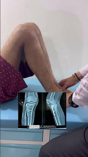 ACL INJURY WITH KNEE PLATTING