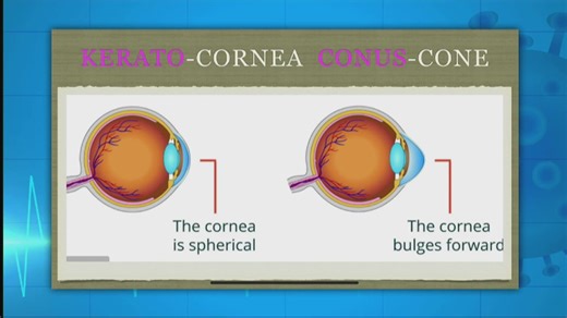 20 reactions · 5 comments | Dr. Priyanka Bhuyar: Causes of vision impairment include inflammation of the optic nerve and swelling of the cornea, which can develop suddenly and are often detected quickly #CitizenDayBreak | Citizen TV Kenya | Facebook