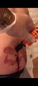 Removed Knife From Hole In Belly