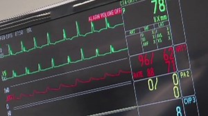 New stroke guidelines: What it means