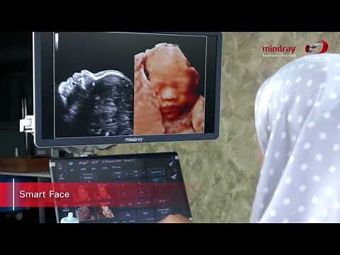 Mindray Consona N Series 3D Printing Fetal Scan