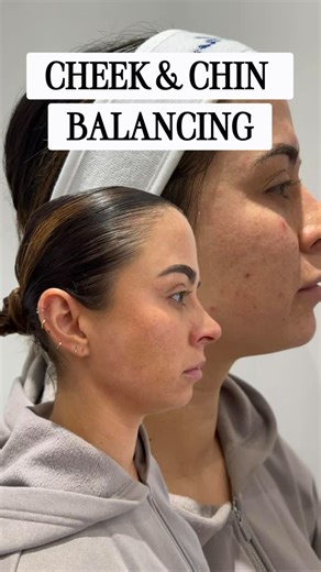 Lisa Moore Therapy on Instagram: "Before & After ✨ Cheek & chin facial balancing using Restylane Defyne — subtle definition, natural harmony, and beautifully refreshed contours. Perfect for the New Year glow-up 💫 #LisaMooreTherapy #FacialBalancing #RestylaneDefyne"