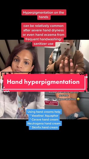 Hand Hyperpigmentation: Causes and Solutions