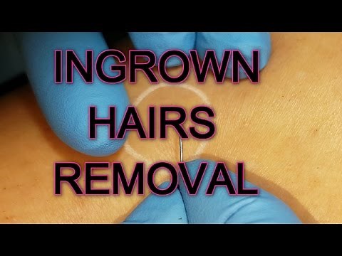 Ingrown Hair Removal I