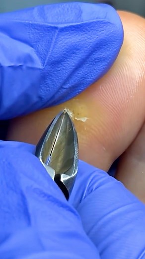 Foot callus removal! | Alena Lavrenteva