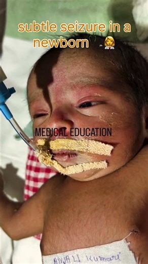 A subtle seizure in a newborn.