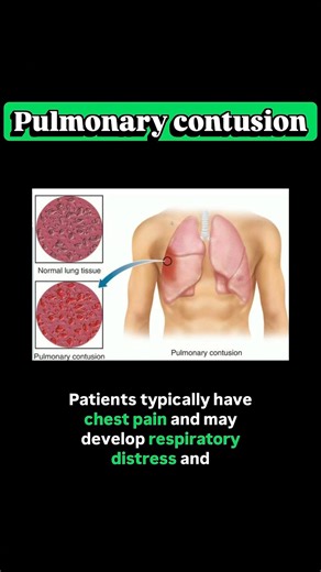 Pulmonary contusion and blunt chest trauma #lungs #trauma #chestpain #emergency #neetpg #anatomy
