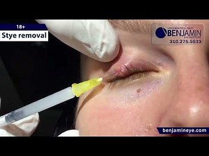 Saying Goodbye to Styes: Dr. Arthur Benjamin's Expert Procedure