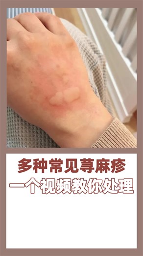 多种常见荨麻疹，一个视频教你处理