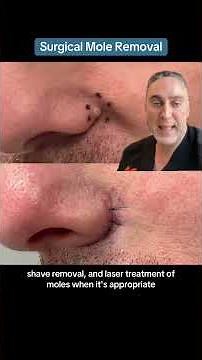 Surgical Mole Removal