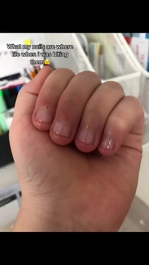 Come on my your name to stop biting my nails!!❤️ #stopbitingmynails #day1 #followtpseemyimprove #fypシ