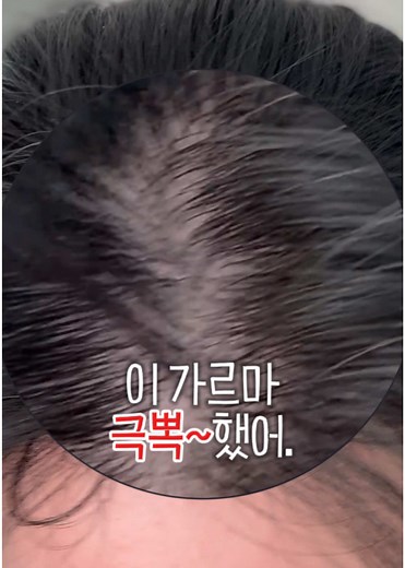탈모 극복을 위한 혁신적인 샴푸 솔루션!