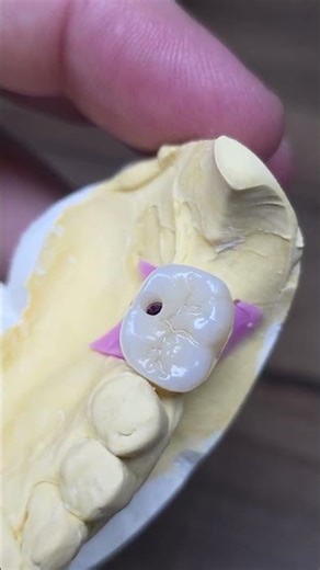 Zirconia Crowns #dentist #dentaltechnician #prosthetics #implant #dentist