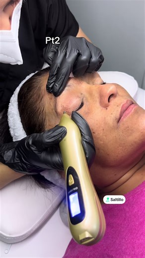 Rejuvenecimiento Facial con Plasma Pen: Tutorial y Tips
