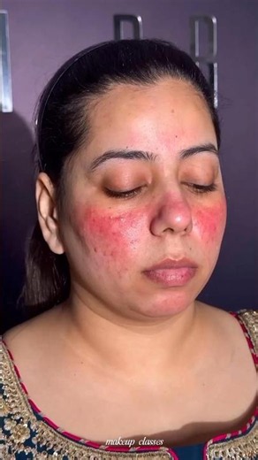 Acne & Redness Cover Makeup Tutorial ✨#makeup #makeuptutorial #makeupartist