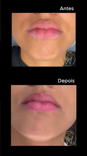 Antes e Depois da Frenectomia Lingual! ✨Anquiloglossia, Vulgo "língua presa"