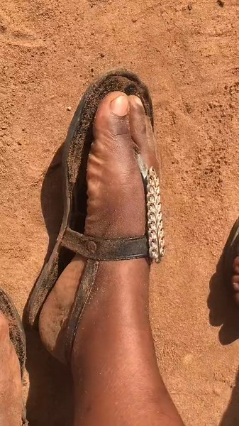 Dealing with Hyperhidrosis: Understanding the Condition