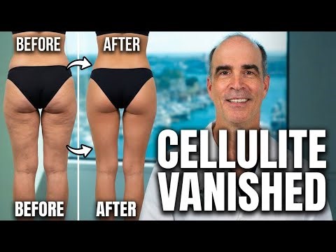 She Didn't Recognize Her Butt After This Bikini Lift