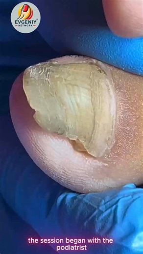 Thickened toenails: calm care with safe products #SafeAtHome #EverydayWellness #SeniorWellness | Evgeniy