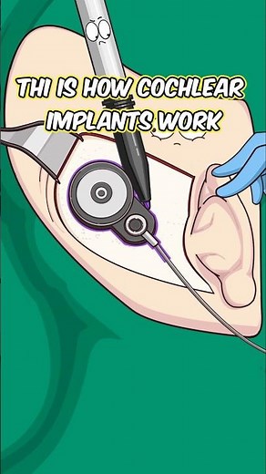 This is how cochlear implants work