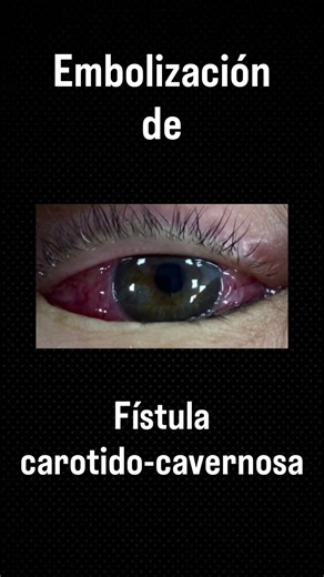 Embolización de fístula carotido-cavernosa #fistulaarteriovenosa #embolizacioncerebral #malformacionarteriovenosa