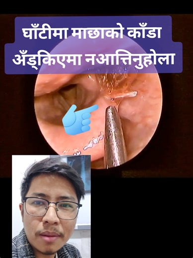 Endoscopic Fishbone Removal in Throat Procedure