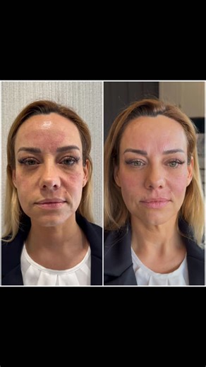 Nicole Smith | California | Botox, Filler, Anti-aging | And how much it costs ⤵️ My patient had mostly midface volume loss so we decided on doing dermal fillers to get immediate correction and... | Instagram