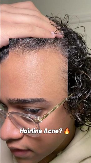 Hairline Acne? 🔥