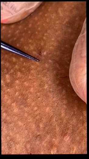 Urban Extraction | Popping and Fishing For Ingrown Hair. Hey Everybody. I Hope You All Are Doing Well! #jadakennedy #waxandextracttour #youtuber #waxclass... | Instagram
