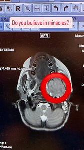 IMPRESSION: 1. Dramatic response to therapy, with no residual mass lesion demonstrated in the left masticator space, foramen ovale, Meckel’s cave or within the basisphenoid and dura of the sella turcica. They said it was response to therapy, but we know it was more than that. #miracles #miraclesdohappen #churchofjesuschristoflatterdaysaints #childhoodcancer | Love For Luke