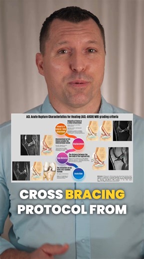 Is ACL healing a myth, or can a torn ACL actually regain continuity and provide knee stability? Today I explored this article with Filbay et al. 2025. Here are five interesting extra points about ACL injuries and the Cross Bracing Protocol (CBP) from this article. Filbay SR, Dowsett M, Van Haeringen M, Palmer E, Roger G, Lucas P, van Den Heever A, Sabharwal R, Cross T. A new way of grading severity of ACL rupture on acute MRI to consider potential for non-surgical healing with the Cross Bracing 