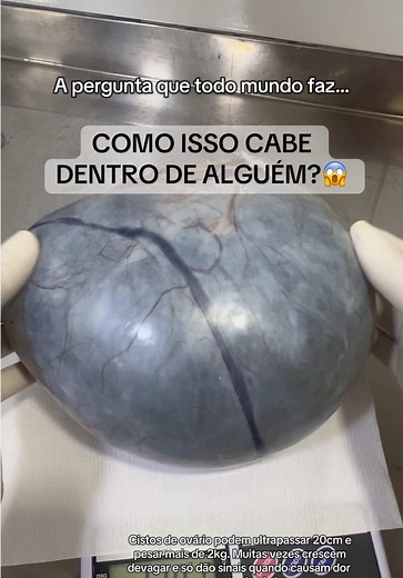 Cistos Ovarianos: O Que Você Precisa Saber
