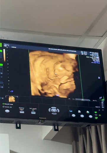 Kehamilan 17 Minggu: Cek Kondisi Janin Normal