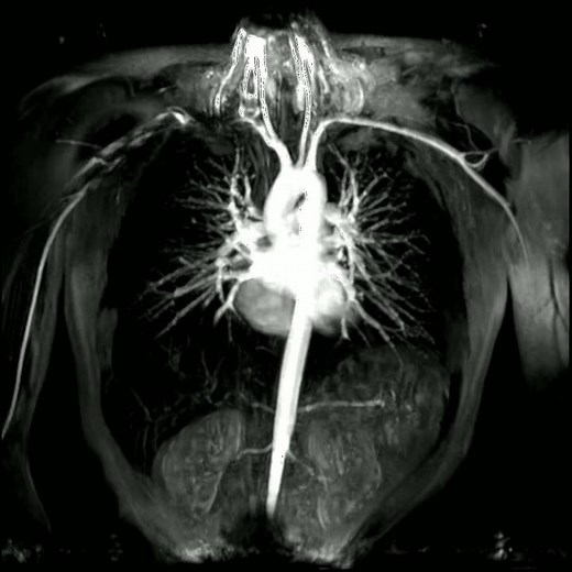 Angiografia dinámica tórax