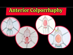 Anterior Colporrhaphy.