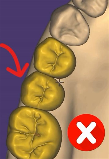 Master Exocad Tooth Carving Techniques Today