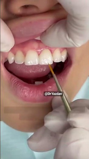 Front tooth crown procedure | dental crown process | Dr. Yazdan cosmetic dentist Newport Beach OC