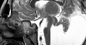 Malformation de Dandy Walker: causes, symptômes et traitement