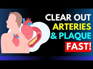 Clean Arteries: How to Remove Plaque Naturally.
