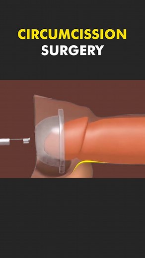 Circumcision Surgery 3D Medical Animation #circumcission #circumcisiom #circumcissionsurvivor🙏 #medicalprocedure #genderchange #genderchangechallenge #medical3danimation #genderchanger