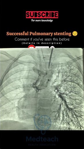 Life-Saving Procedure: What Is Pulmonary Stenting? #youtubeshorts