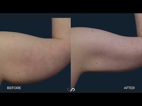 Brachioplasty (Arm Lift) | Before and After | Dr. David Stoker