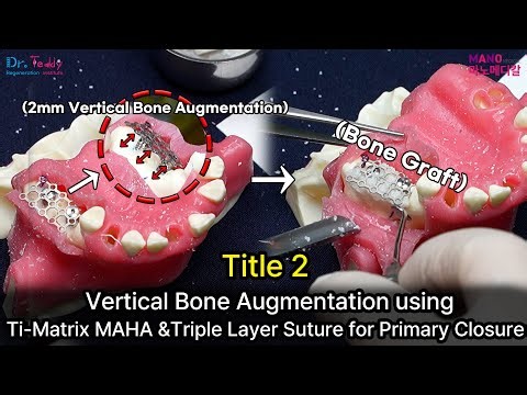 Title 2 : Vertical Bone Augmentation using Ti-Matrix MAHA &Triple Layer Suture for Primary Closure