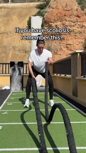 A strong and stable spine is the best goal to have with scoliosis. This will improve your posture, prevent pain and progression and allow you to live your life to the fullest with a curvy spine. A structural scoliosis means your spine can never be 100% straight, no matter what. So making this your goal is setting yourself up for failure. But it can be strong and stable… this is what we should be focusing on 💪💪 If you need help with your scoliosis and exercise, checkout my ScoliSTRONG community