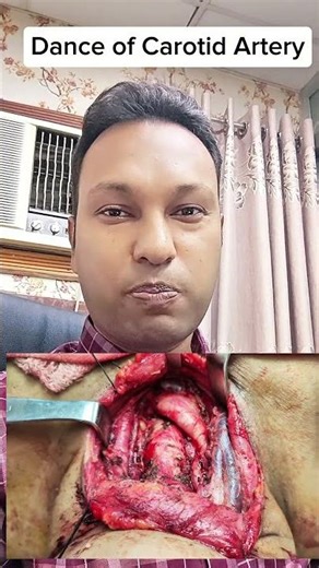 Dance of Carotid Artery during Neck Dissection
